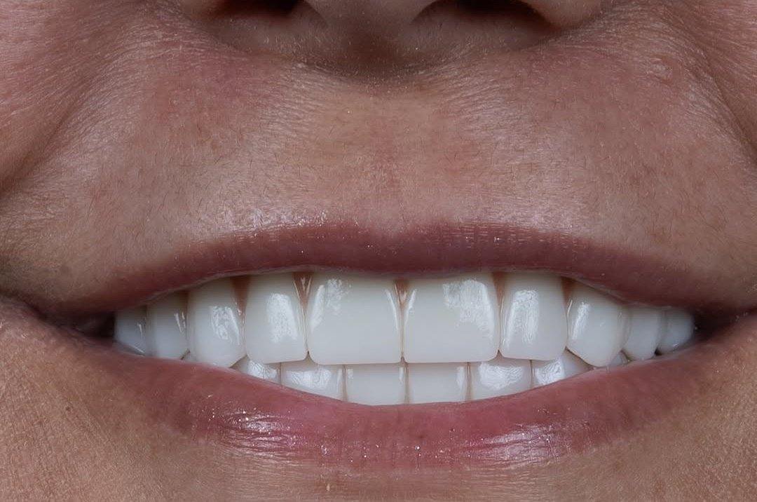 Real TiDent patient — before and after treatment